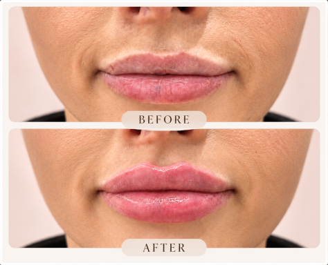 Close-up of naturally enhanced lips showing definition and volume following a lip filler treatment.