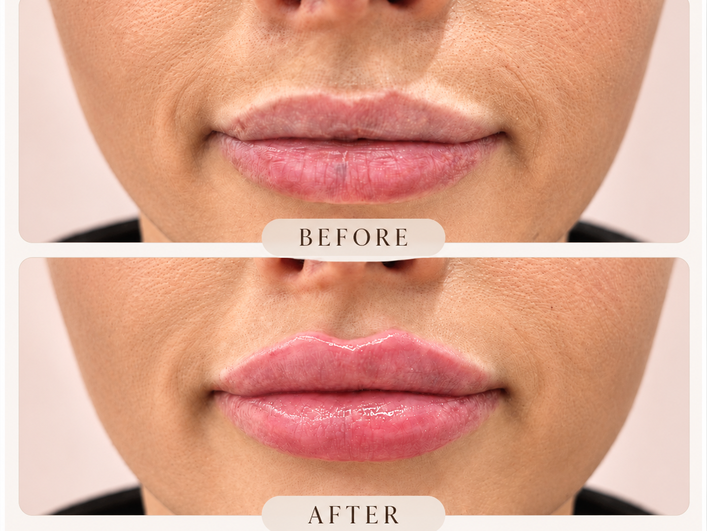 Discover skin boosters, polynucleotides and Profhilo at Oakleigh Glow Aesthetics in Cliffe Woods, Medway. Personalised treatments for healthier-looking skin.