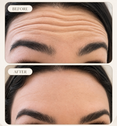 Before and after forehead anti-wrinkle treatment showing visibly softened lines at Oakleigh Glow Aesthetics.