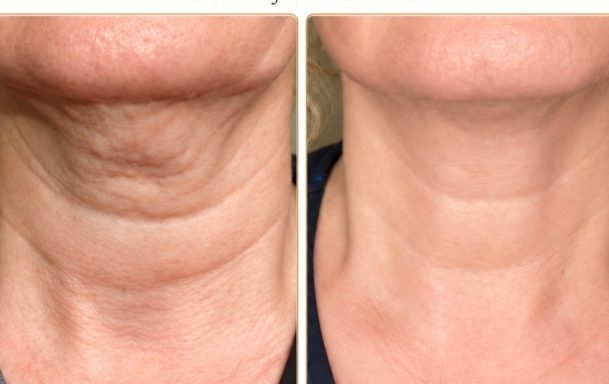 Woman with radiant skin alongside Profhilo injectable skin treatment product for skin rejuvenation.
