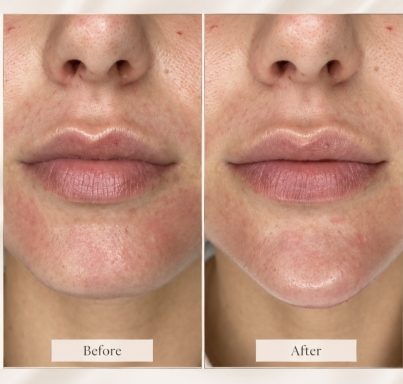 Before and after dermal filler treatment showing enhanced facial contours and definition.