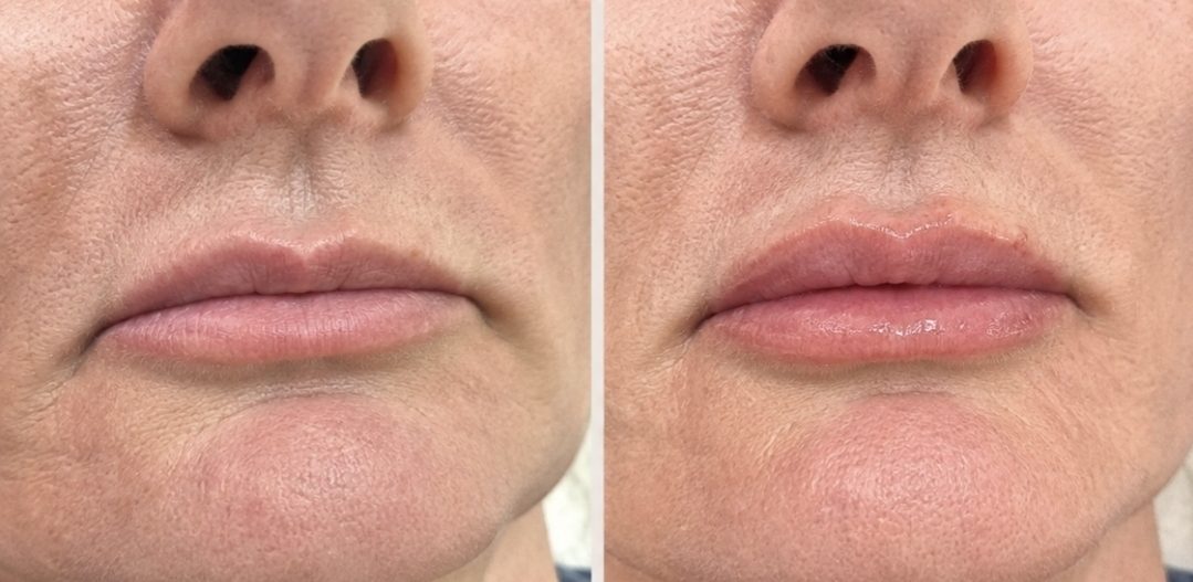 Discover skin boosters, polynucleotides and Profhilo at Oakleigh Glow Aesthetics in Cliffe Woods, Medway. Personalised treatments for healthier-looking skin.