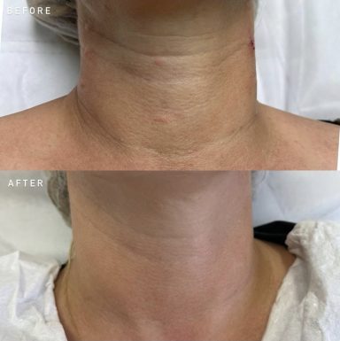 Polynucleotide skin rejuvenation injection being administered to the facial area by an aesthetic practitioner.