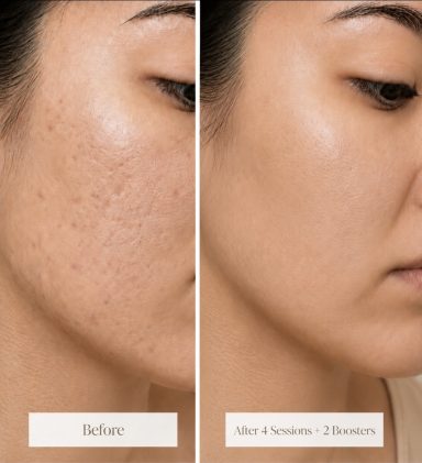Microneedling facial treatment to stimulate collagen production and improve skin texture at Oakleigh Glow Aesthetics.